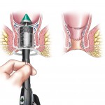 Circular Staplers for Rectal Prolapse and Haemorrhoids usage